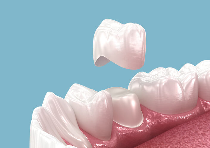 Dental Crowns At Muldoon Dental Arts